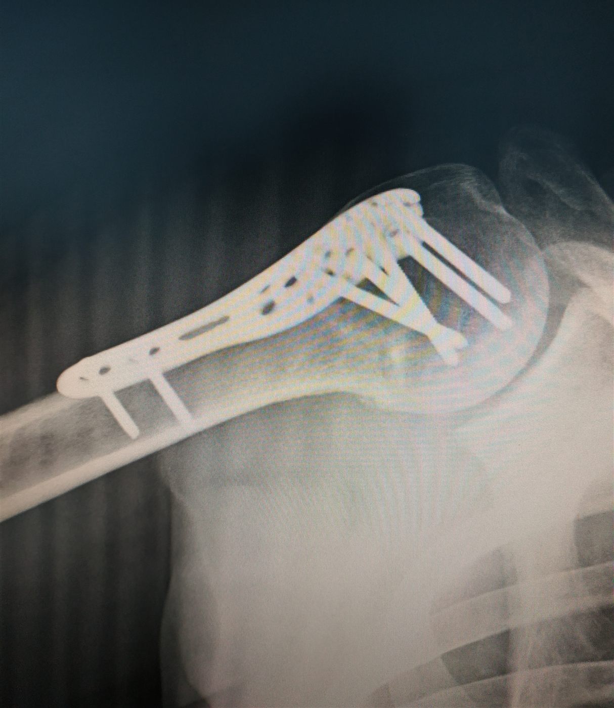 Radiografia della spalla destra con la placca in titanio e le viti nell'omero
